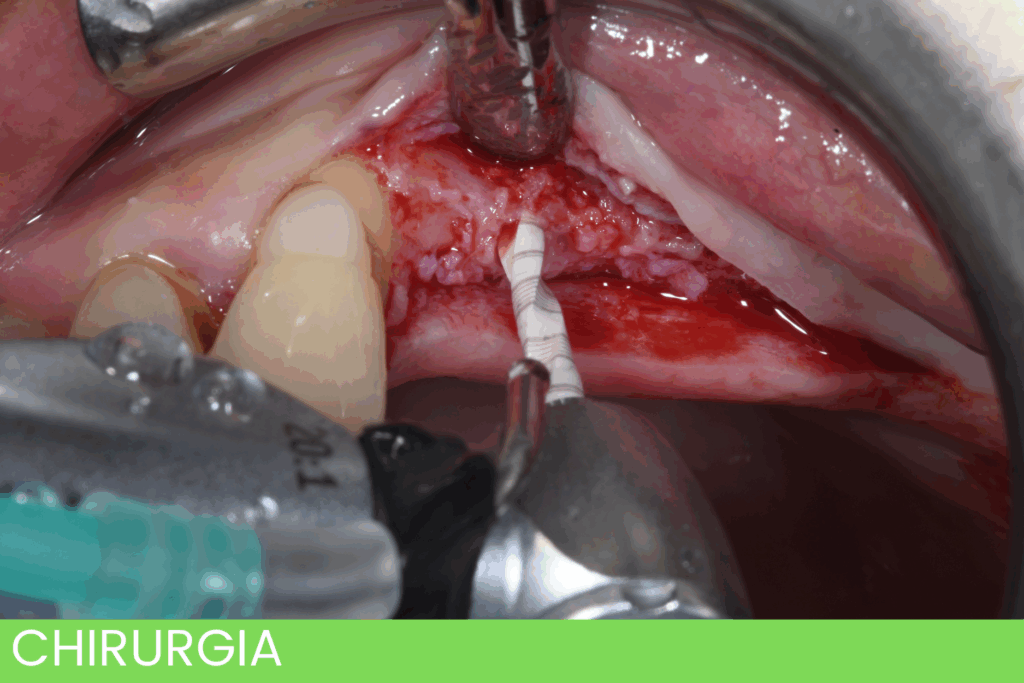 Corso Chirurgia Implantare | Roberto Barone | FormaDentis
